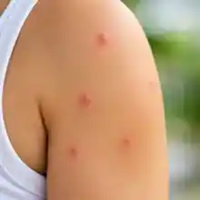 Several separate mild bites on a shoulder