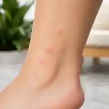 Small cluster of bites on an ankle