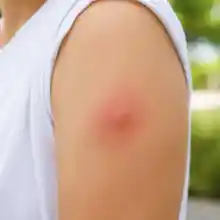 Mild irritated patch with a central bump on an upper arm