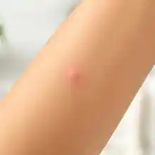 Single small raised itchy bump on a forearm